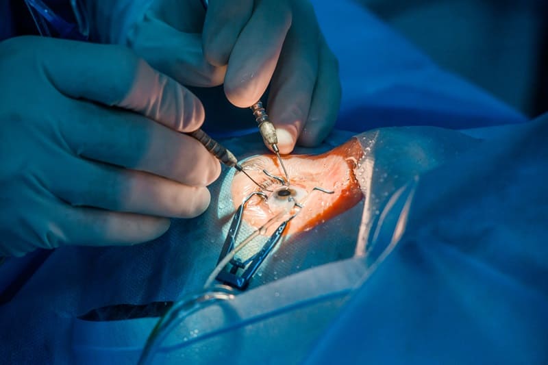 Cirugía de cataratas con implante de lente